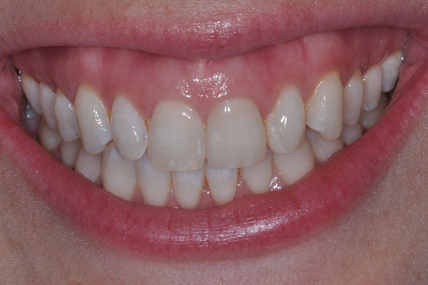 Ceramic Veneers | Esthetic Dentistry | Devin Joseph Okay DDS PC ...